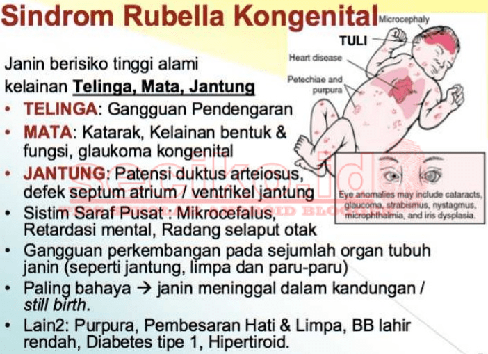 sindrom rubella kongenital