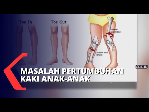 Video Cara Mencegah Kelainan Bentuk Kaki Bayi dan Anak-anak 2021