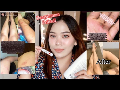 Video Eczema Survivor.. salep ampuh untuk eksim.. dan cara mengobati eksim kalo lagi kambuh! 2021