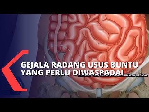 Video Pahami Gejala, Penyebab Hingga Cara Mencegah Radang Usus Buntu 2021