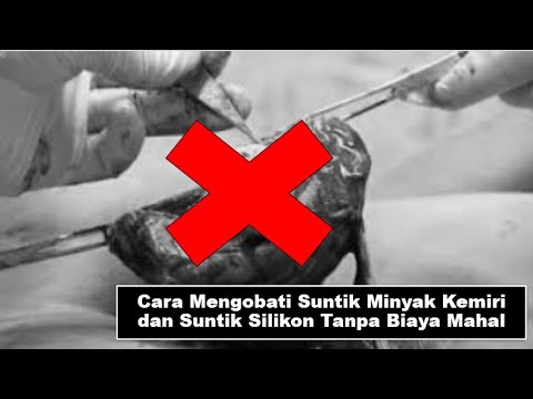 Video Cara Mengobati Suntik Minyak Kemiri dan Suntik Silikon 2021