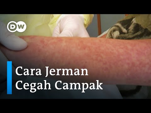 Cara Jerman Cegah Wabah Campak Agar Jangan Jadi Ancaman 2021