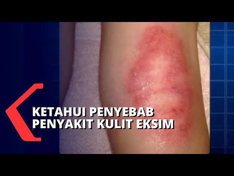 Cara Mencegah Penyakit Kulit Dermatitis Atopik atau Eksim 2021