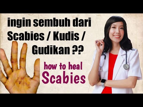 Cara mengobati Scabies / Kudis / Gudikan // How to heal Scabies 2021